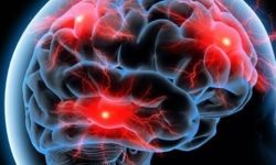 إيران تنجح بإنتاج دواء إشعاعي يكشفُ مرض الزهايمر قبل 20 عاماً من ظهوره